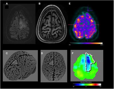 Automated Online Quantification Method for 18F-FDG Positron Emission Tomography/CT Improves Detection of the Epileptogenic Zone in Patients with Pharmacoresistant Epilepsy